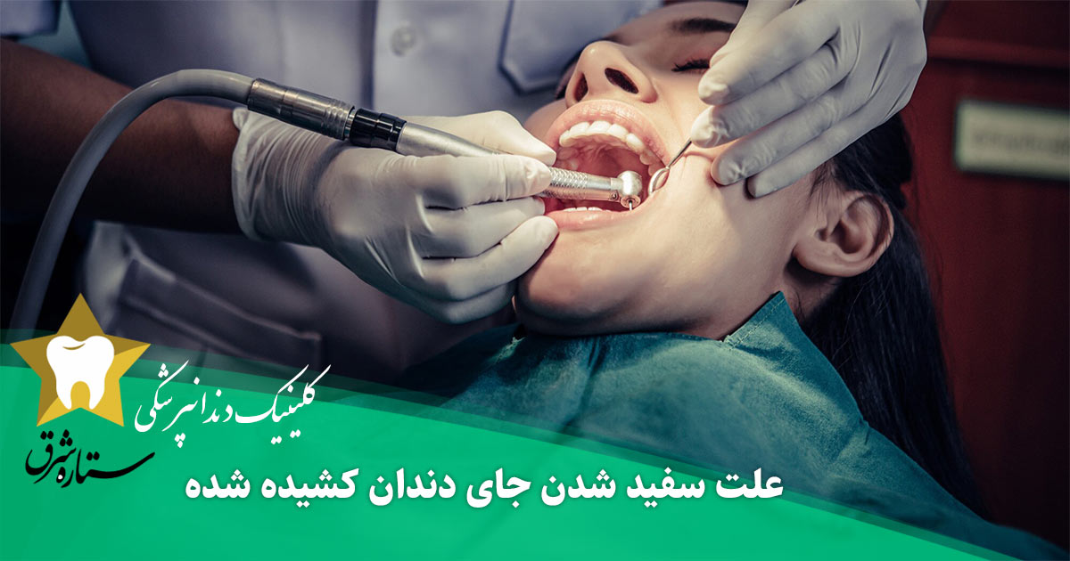 سفید شدن جای دندان کشیده شده نشانه چیست + راهکار درمان