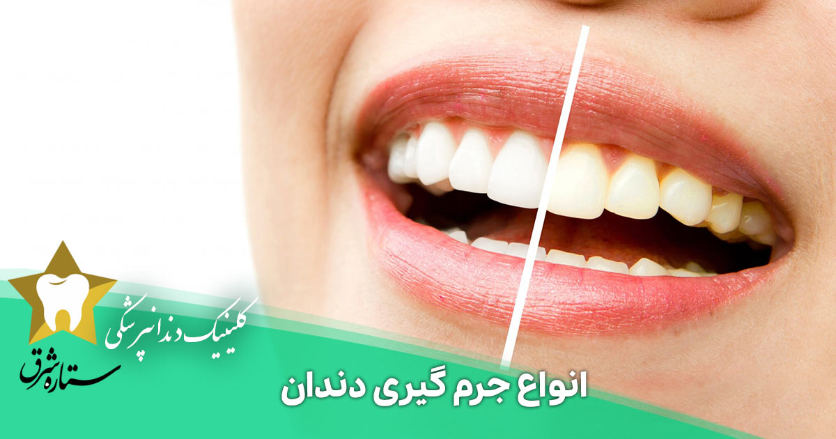 جرم گیری دندان چیست؟