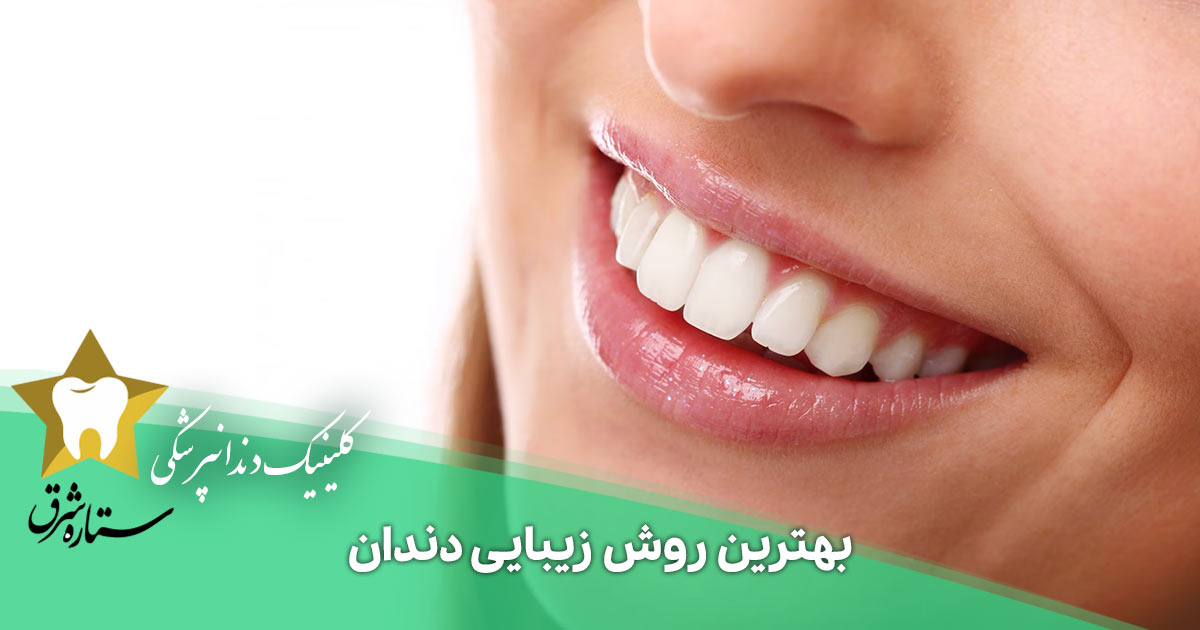 بهترین روش زیبایی دندان کدام است؟