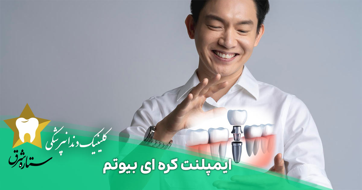  همه چیز درباره ایمپلنت کره ای بیوتم