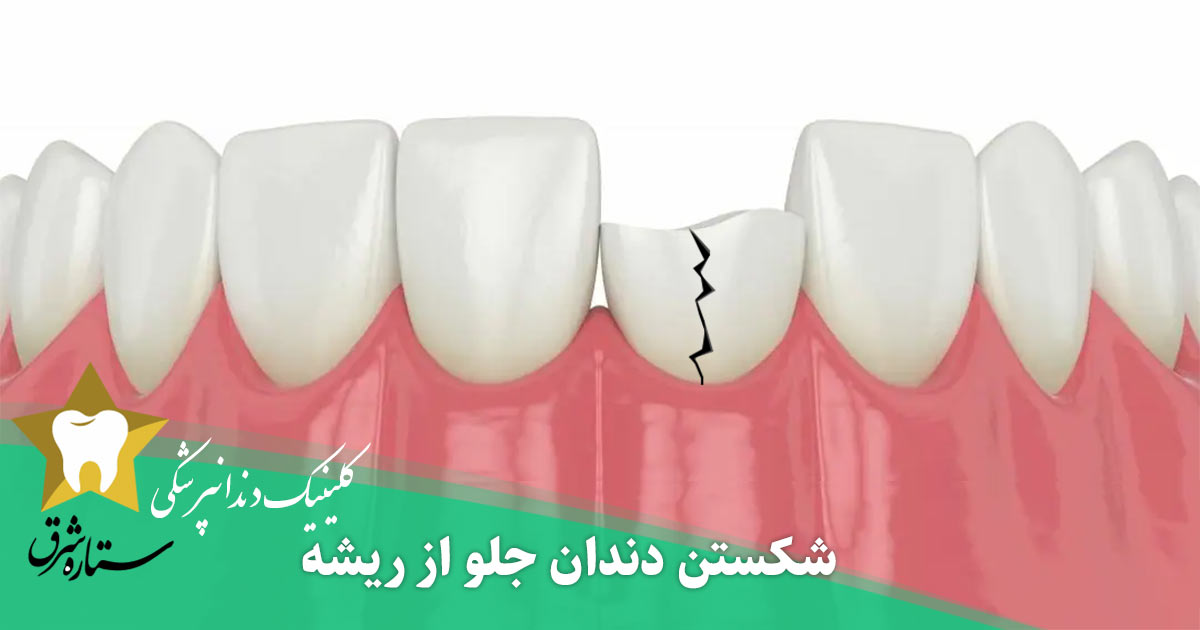  شکستن دندان جلو از ریشه و همه چیز درباره آن