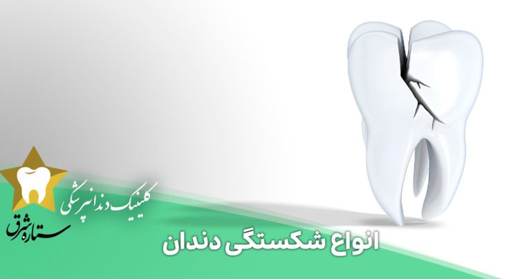 انواع شکستگی دندان که باید بدانید