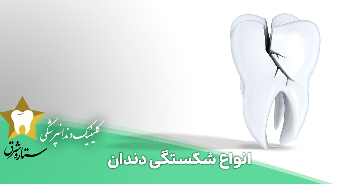 انواع شکستگی دندان که باید بدانید