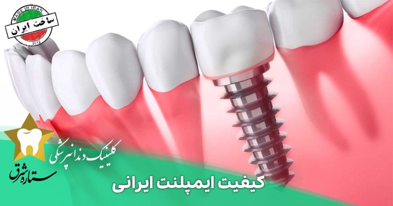 هر آنچه درباره کیفیت ایمپلنت ایرانی باید بدانید