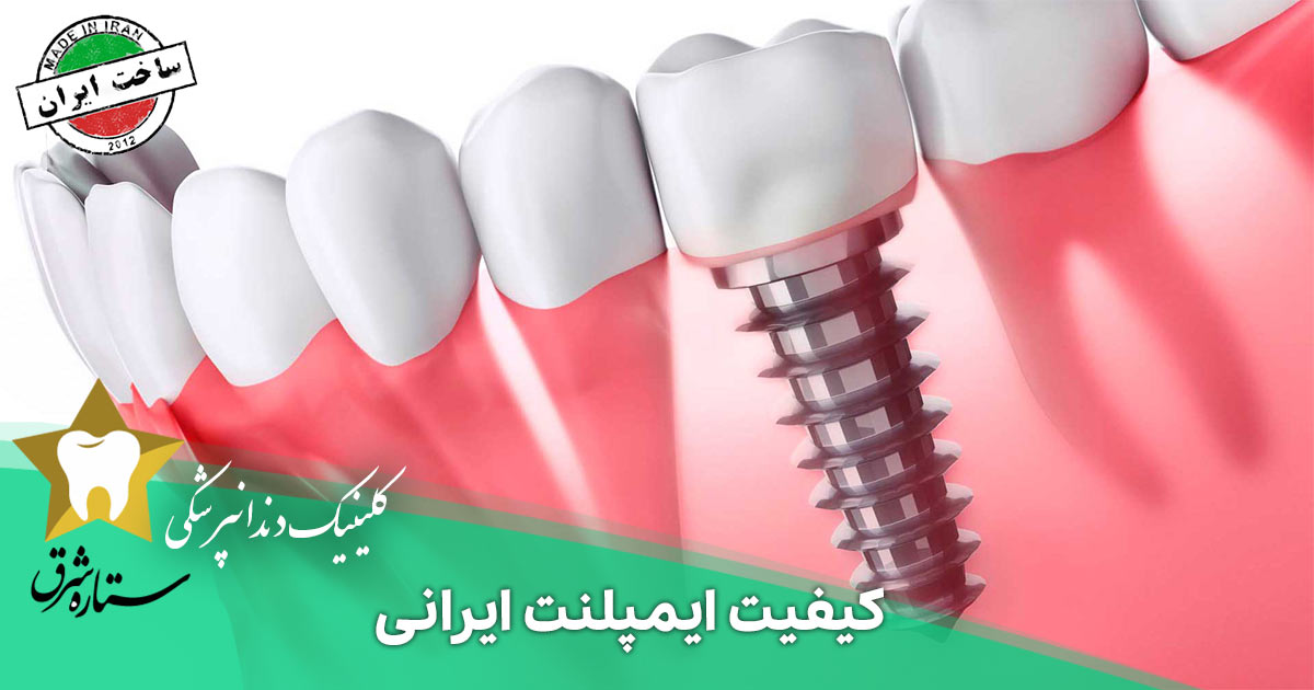 هر آنچه درباره کیفیت ایمپلنت ایرانی باید بدانید