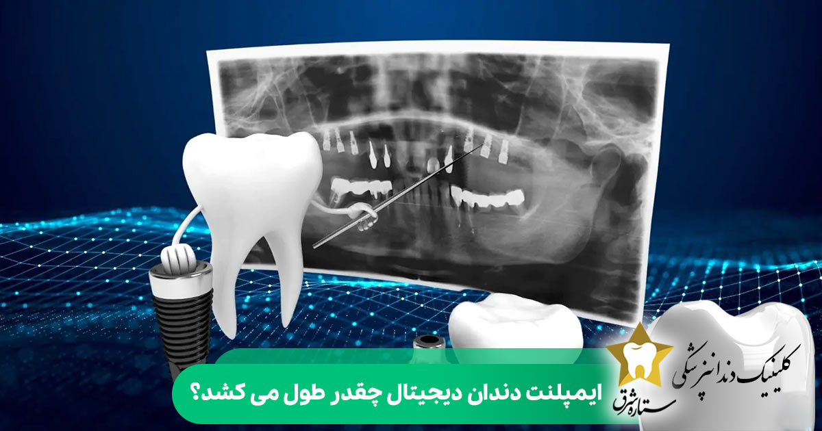 ایمپلنت دندان دیجیتال چقدر طول می کشد؟