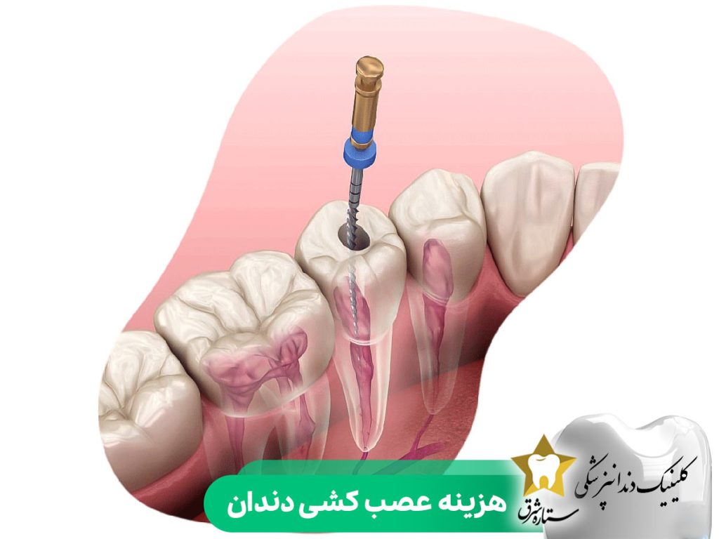 هزینه عصب کشی دندان