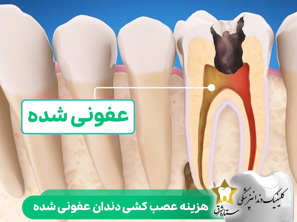 هزینه عصب کشی دندان عفونی شده