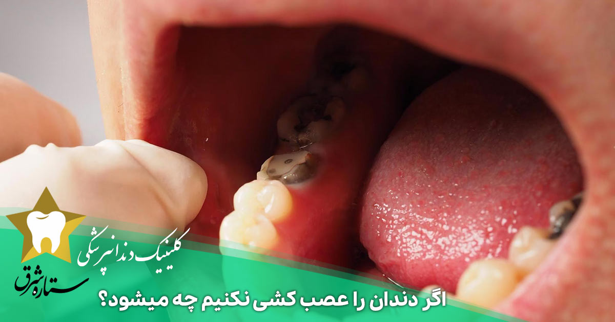 اگر دندان را عصب کشی نکنیم چه میشود؟