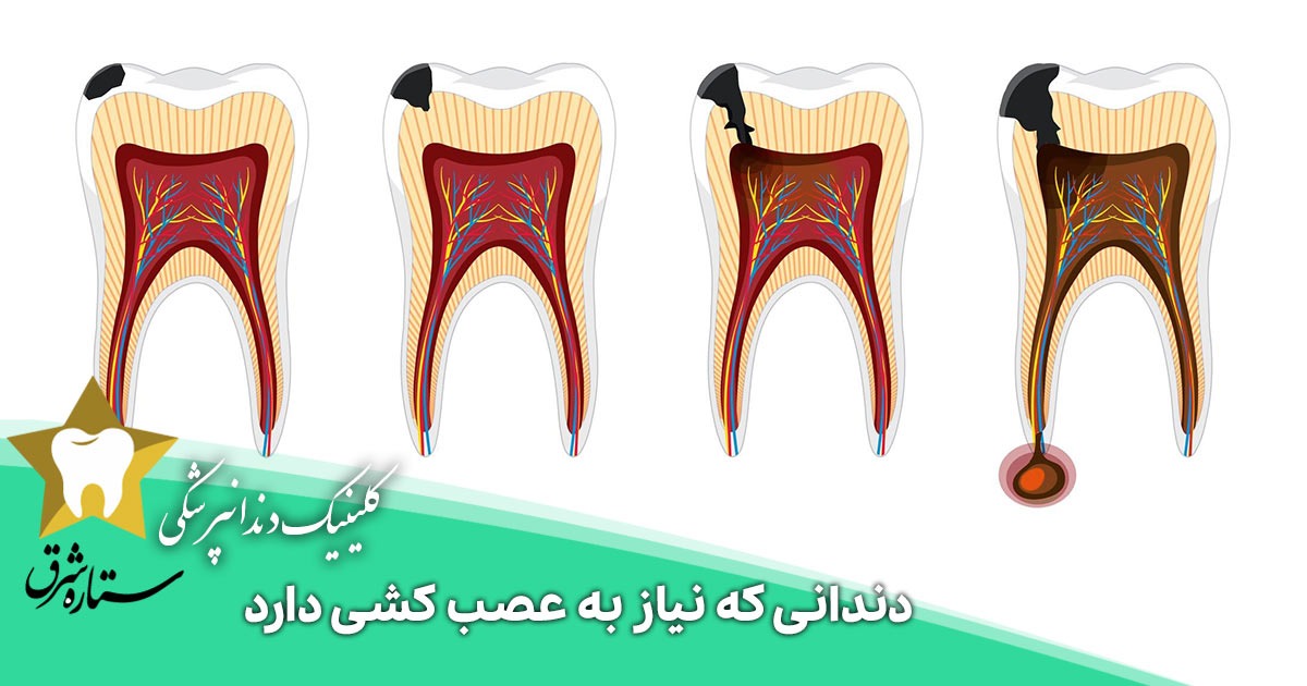 عکس دندانی که نیاز به عصب کشی دارد