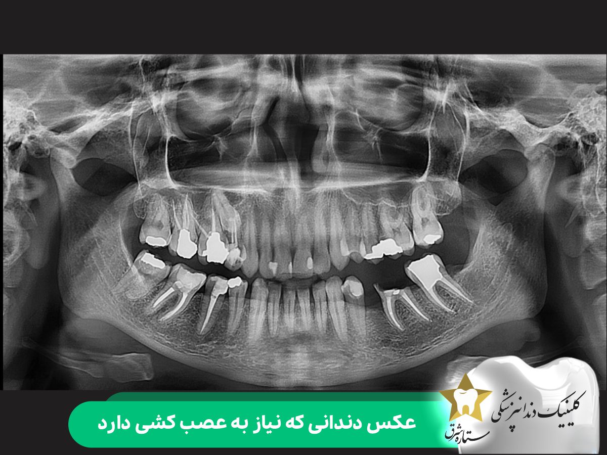 عکس دندانی که به عصب کشی نیاز دارد