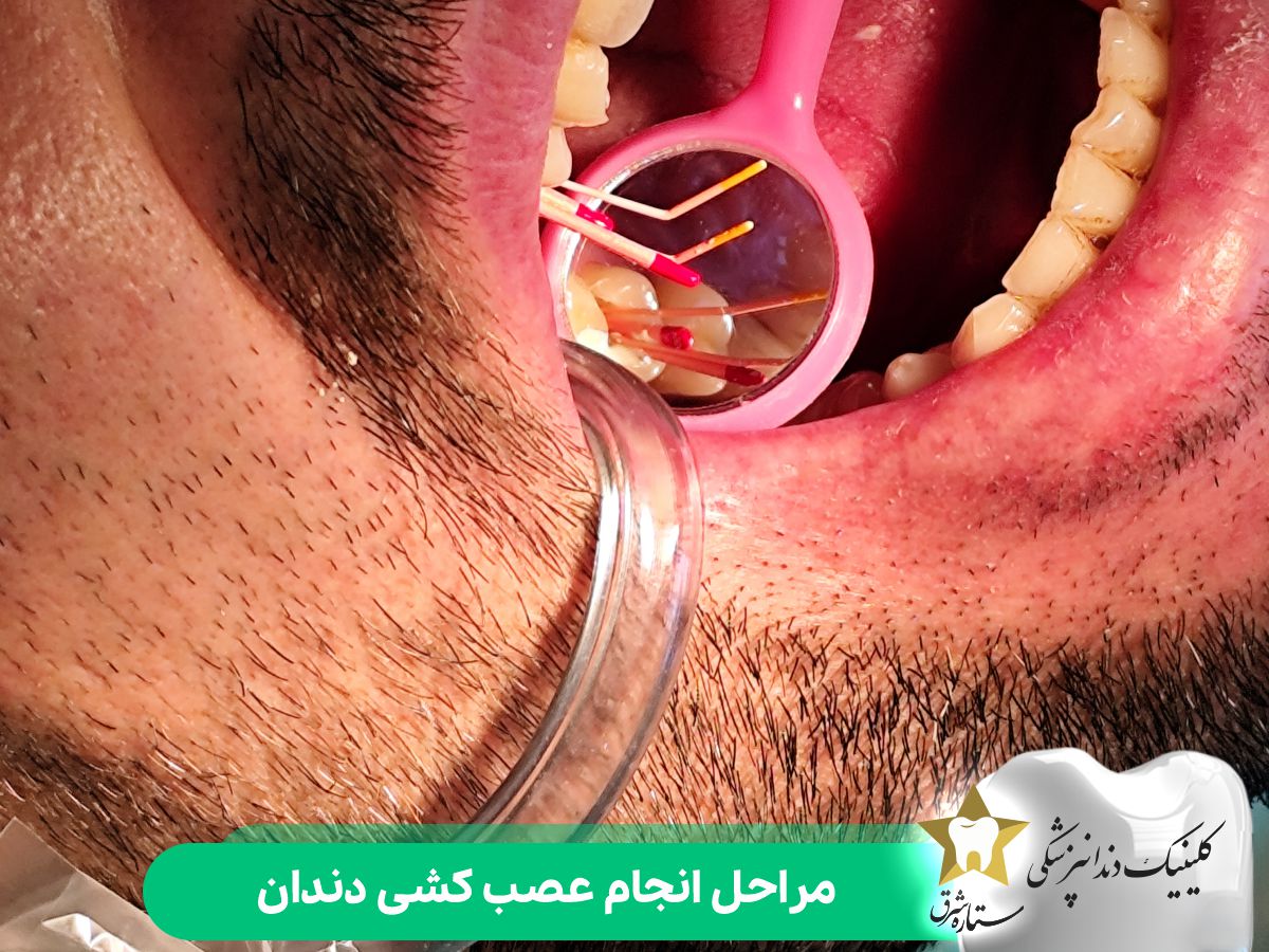 مراحل انجام عصب کشی دندان