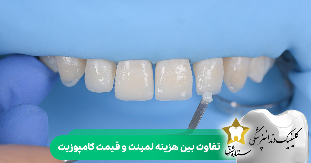تفاوت بین هزینه لمینت و قیمت کامپوزیت