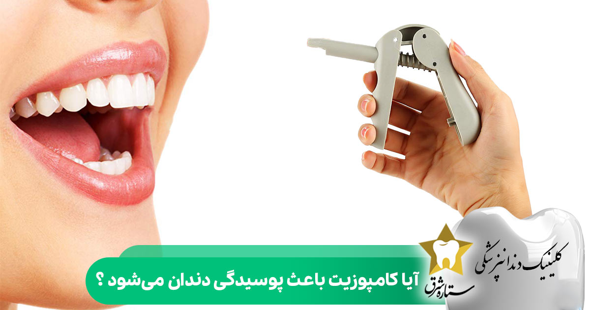 آیا کامپوزیت باعث پوسیدگی دندان می شود؟