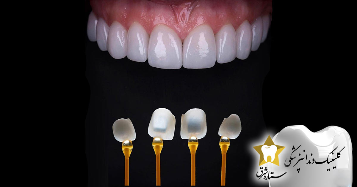 مراحل لمینت دندان 