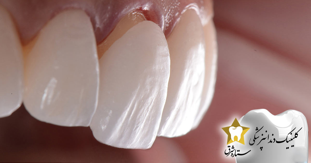 جایگزاری لمینت دندان