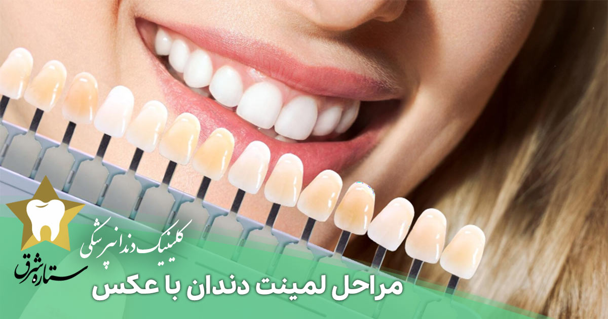 مراحل لمینت دندان با عکس