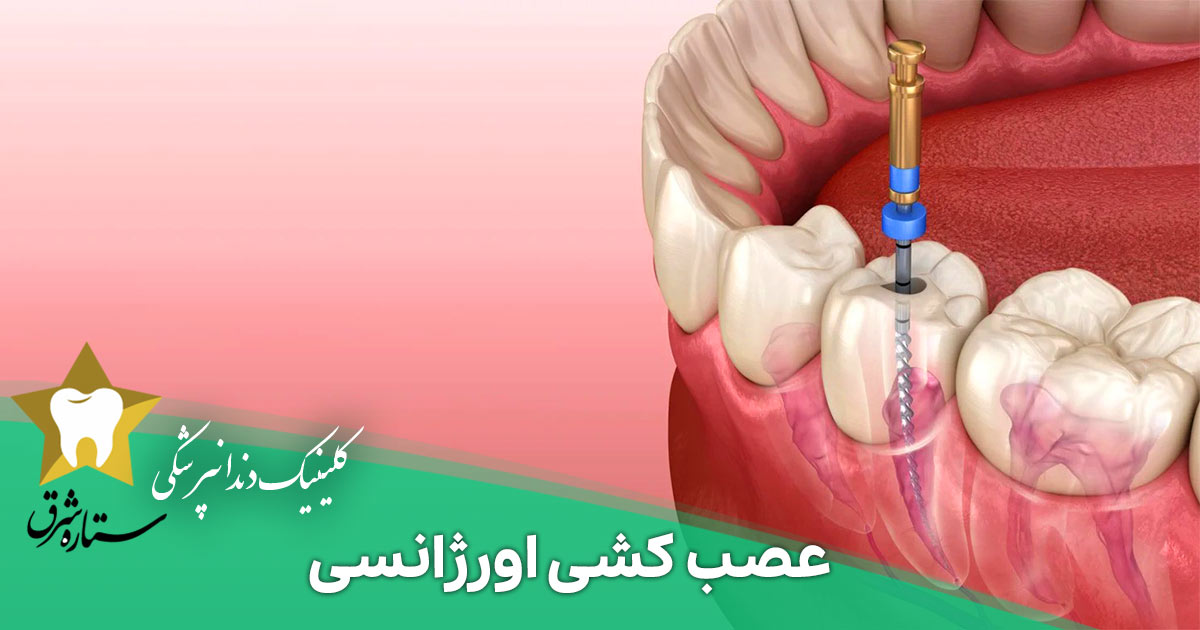 عصب کشی اورژانسی