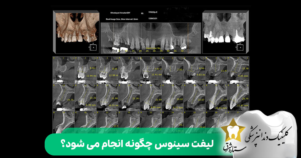 لیفت سینوس چگونه انجام می شود