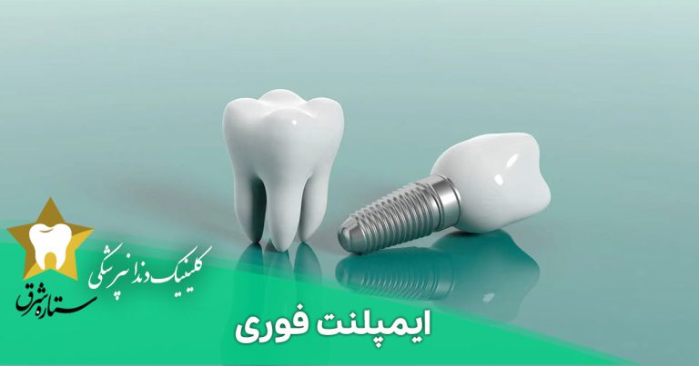ایمپلنت فوری