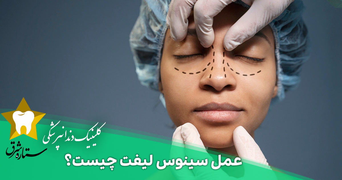 عمل سینوس لیفت چیست؟