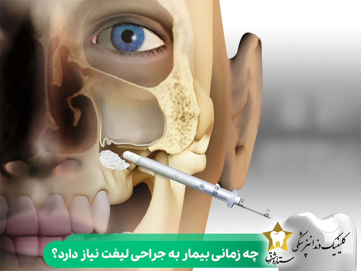 چه زمانی بیمار به جراحی لیفت نیاز دارد؟