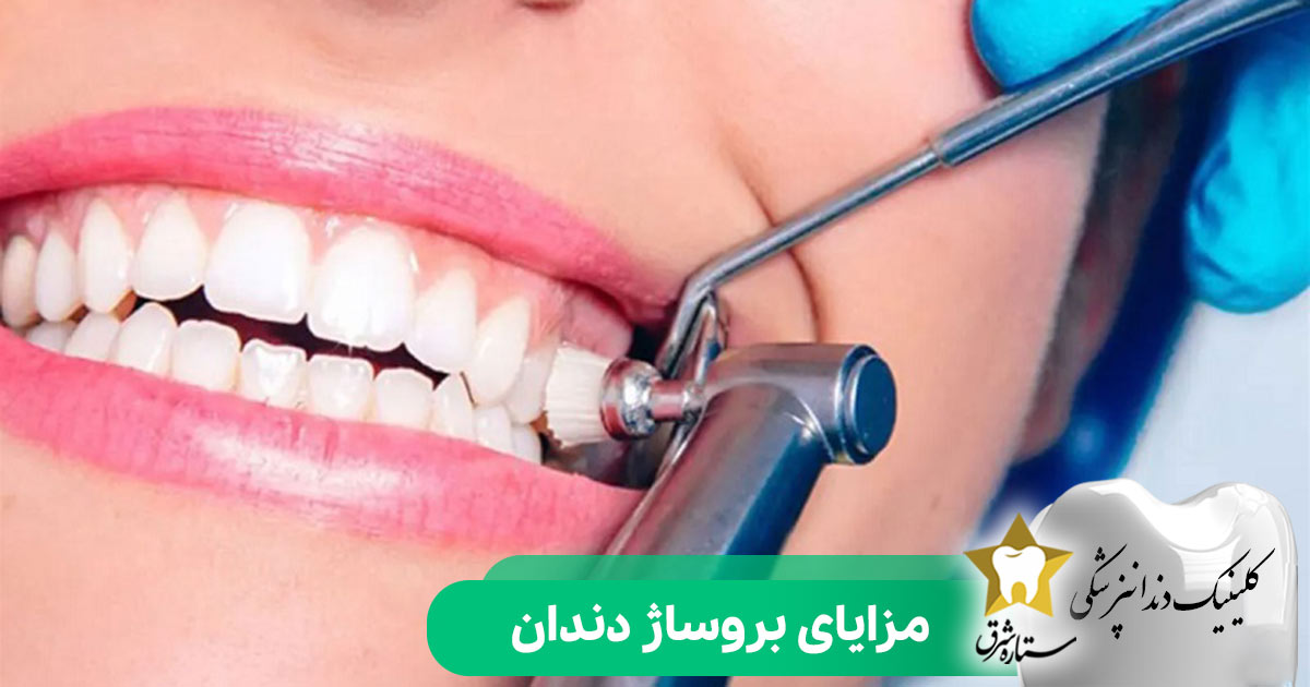 مزایای بروساژ دندان