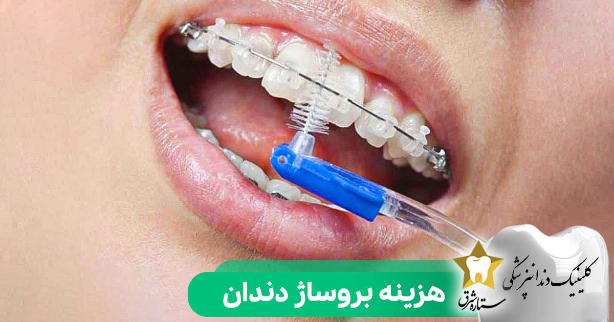 هزینه بروساژ دندان