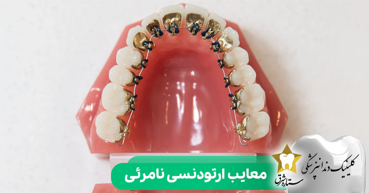 معایب ارتودنسی نامرئی