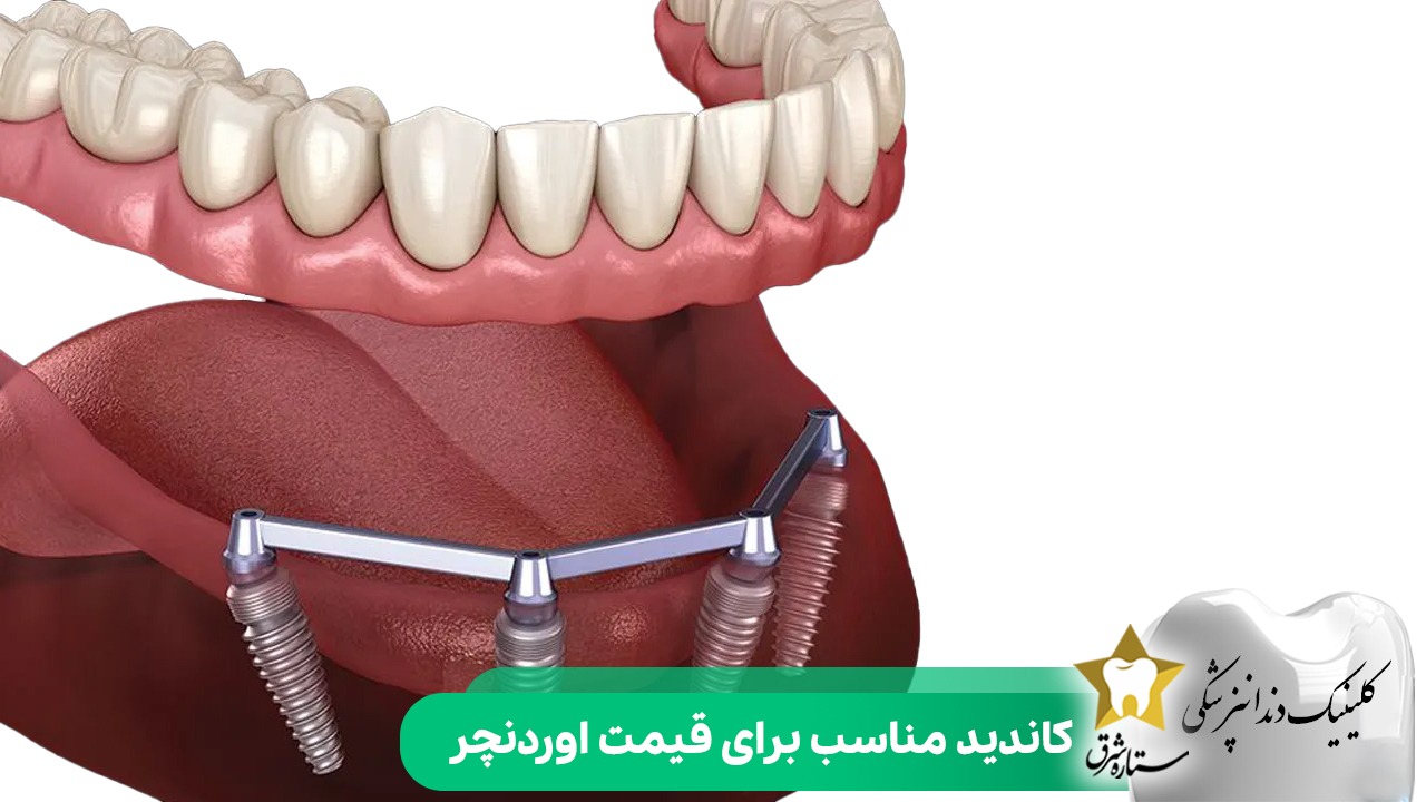 کاندید مناسب برای قیمت اوردنچر