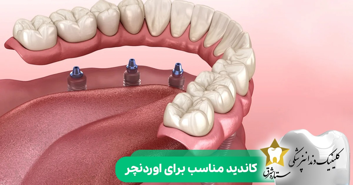 کاندید مناسب برای اوردنچر