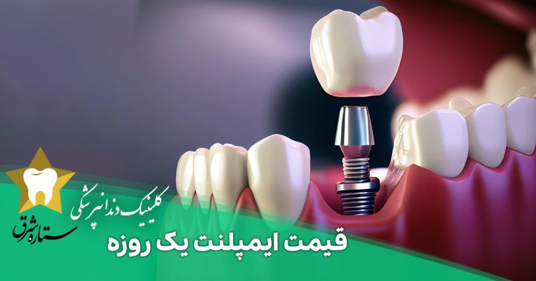 قیمت ایمپلنت یک روزه