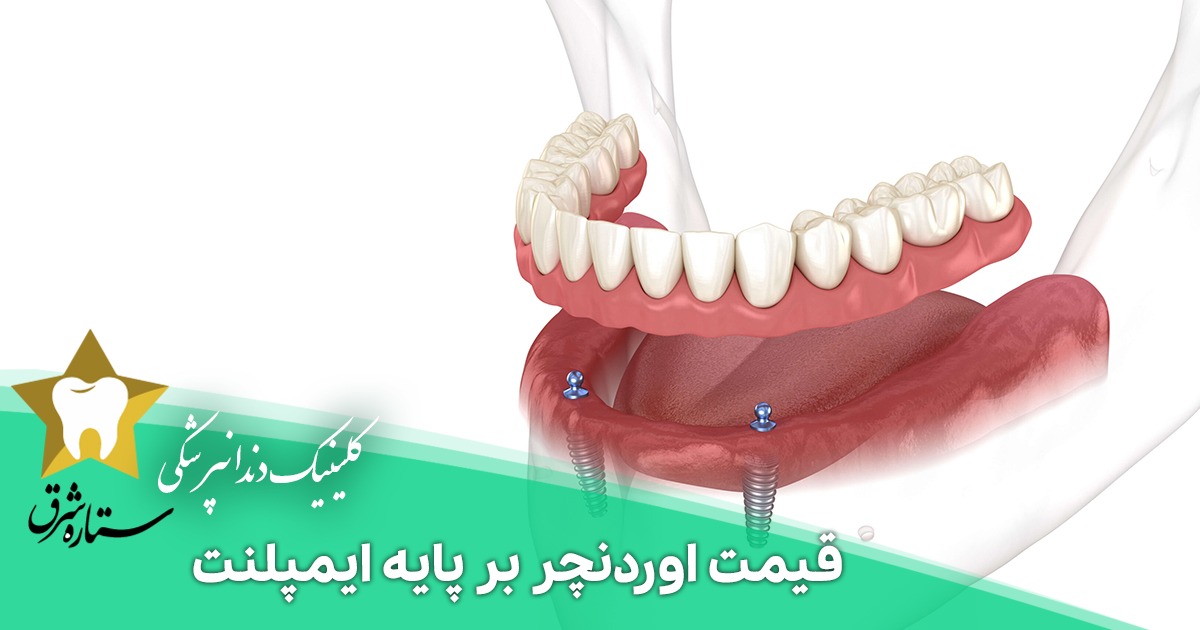 قیمت اوردنچر بر پایه ایمپلنت