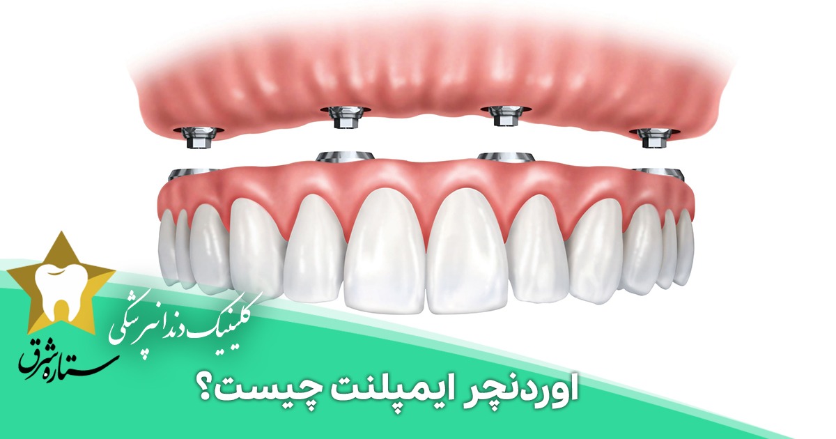 اوردنچر ایمپلنت چیست؟ پروتز دندان بر پایه ایمپلنت