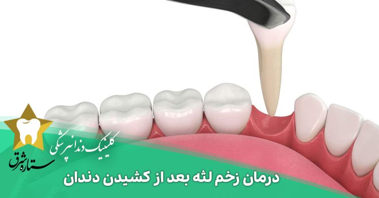 درمان زخم لثه بعد از کشیدن دندان
