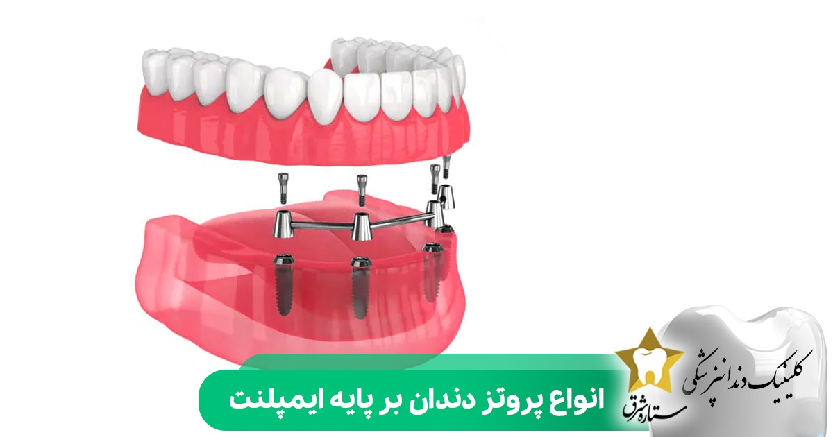 انواع پروتز دندان بر پایه ایمپلنت
