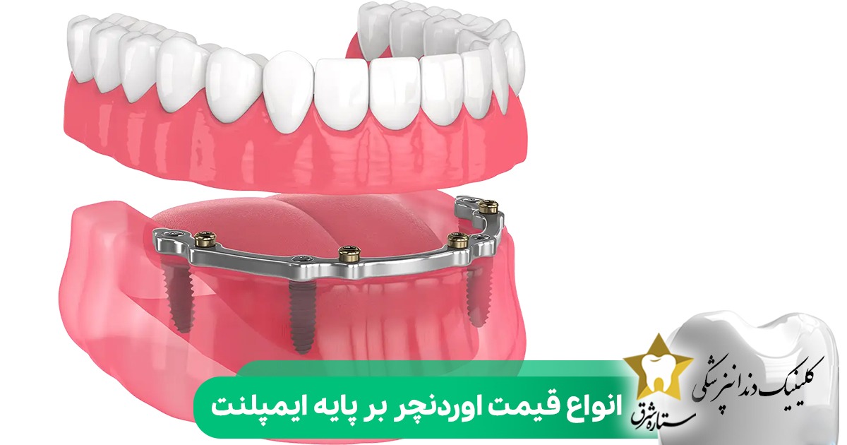 انواع قیمت اوردنچر بر پایه ایمپلنت