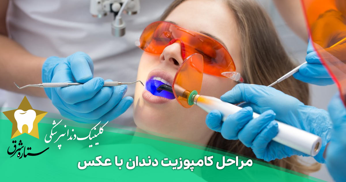 مراحل کامپوزیت دندان با عکس
