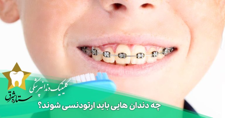 چه دندان هایی باید ارتودنسی شوند؟