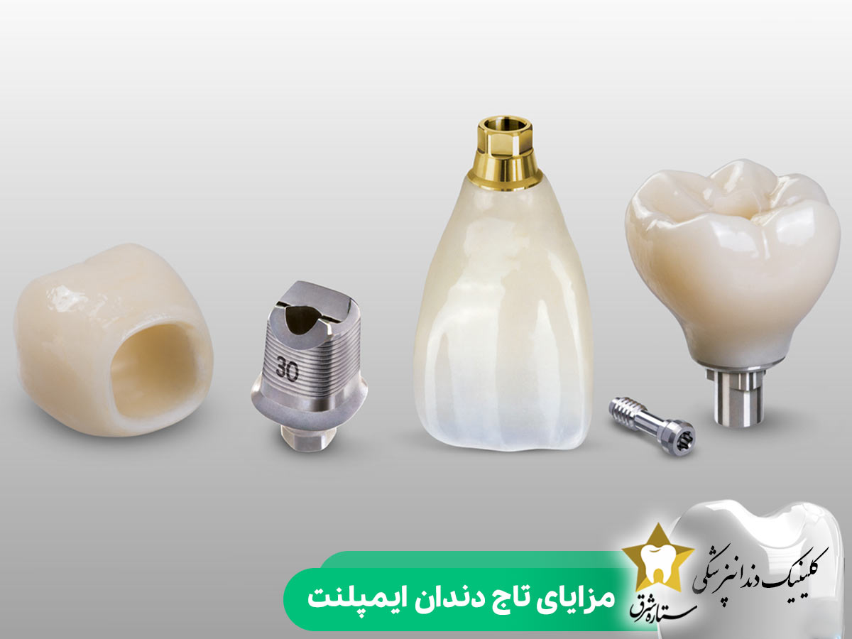 مزایای تاج دندان ایمپلنت