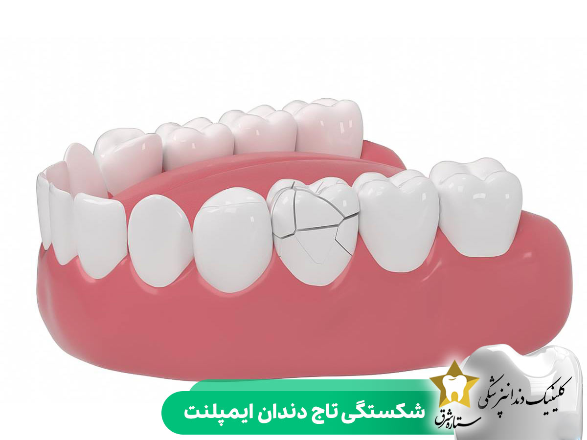 شکستگی تاج دندان ایمپلنت