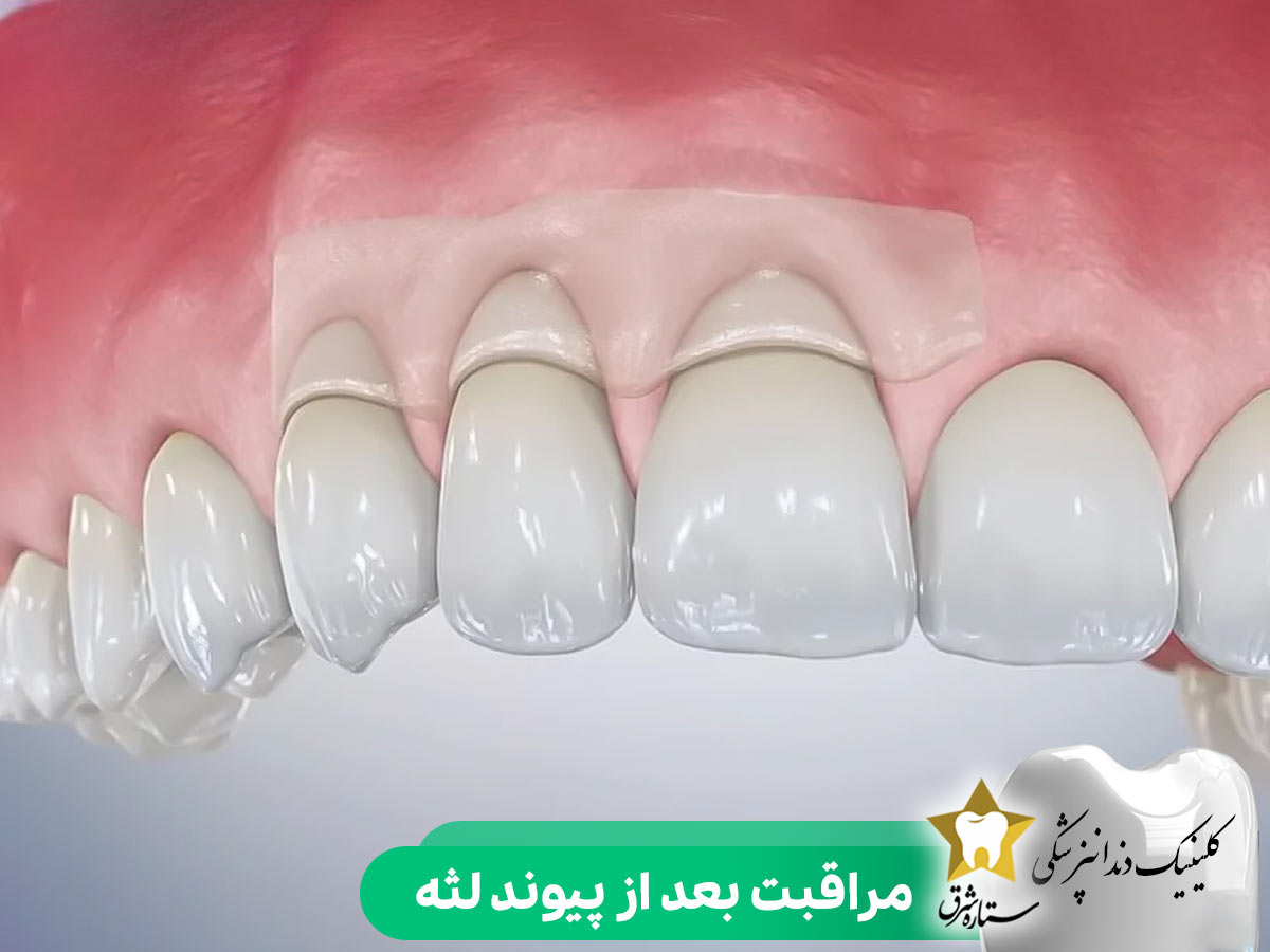 مراقبت بعد از جراحی پیوند لثه
