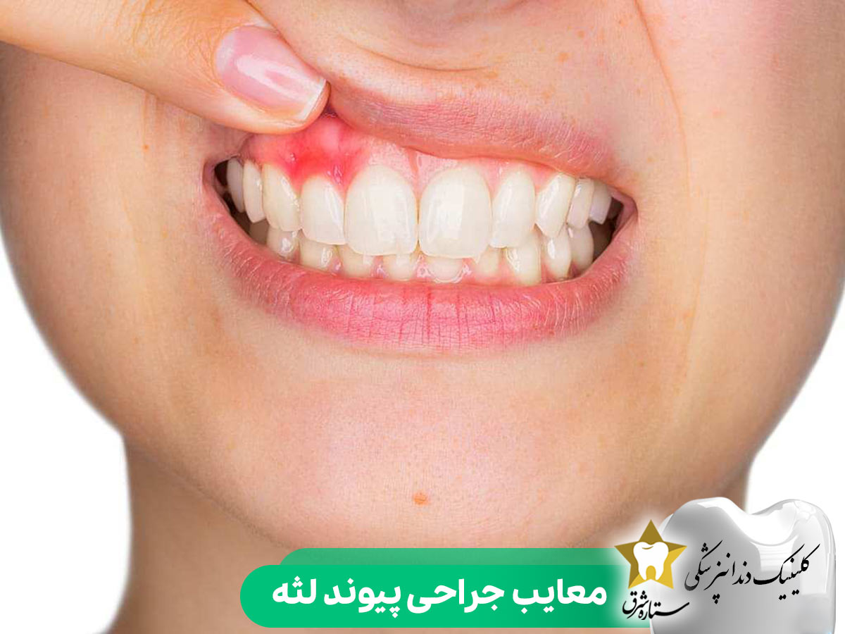 معایب جراحی پیوند لثه