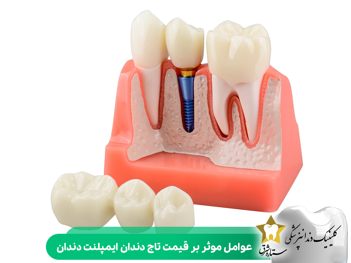 عوامل موثر بر قیمت تاج دندان ایمپلنت دندان