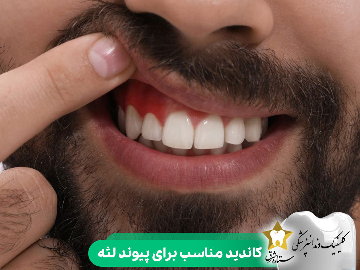 کاندید مناسب برای جراحی پیوند لثه