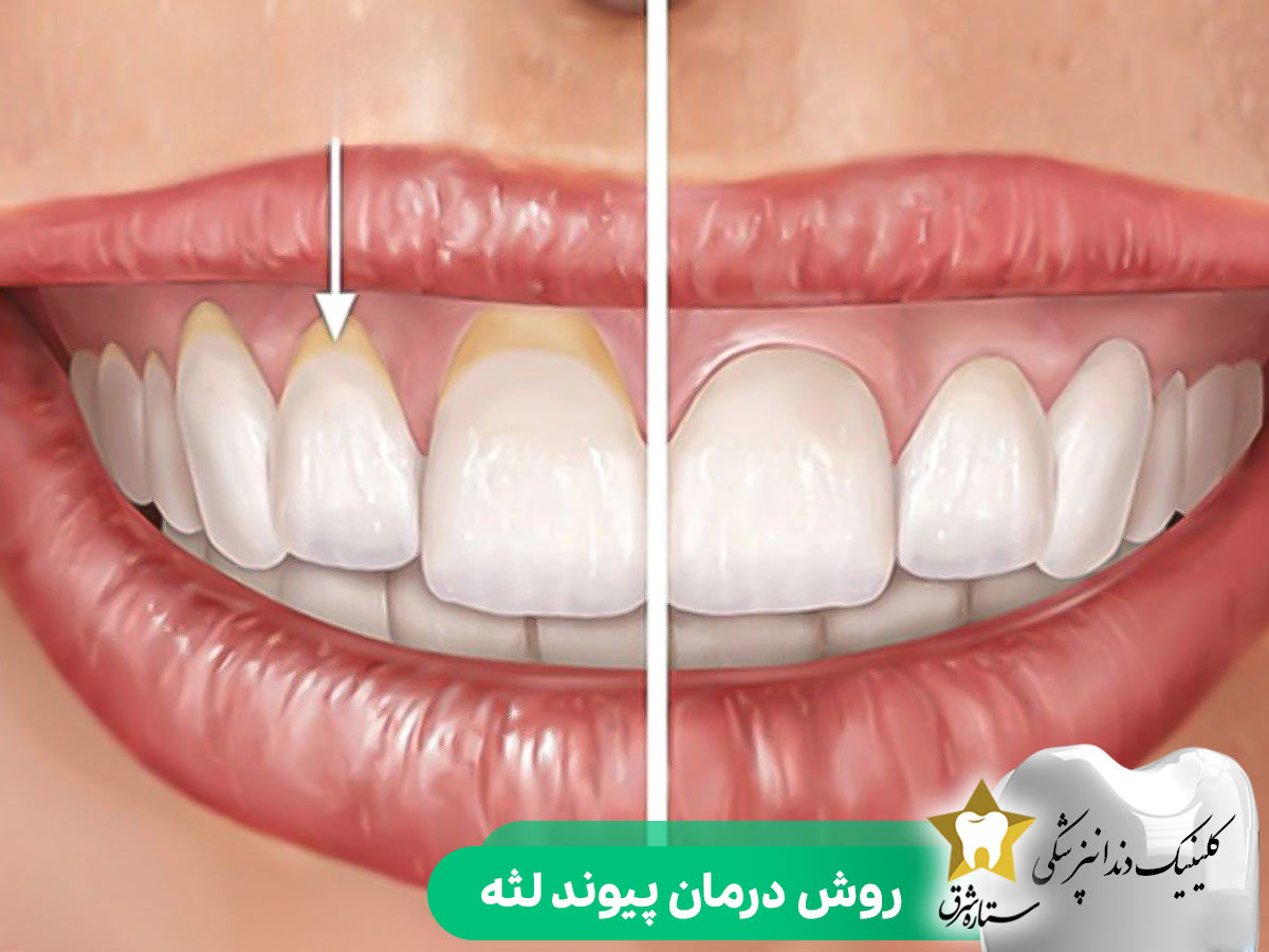 روش درمان جراحی پیوند لثه