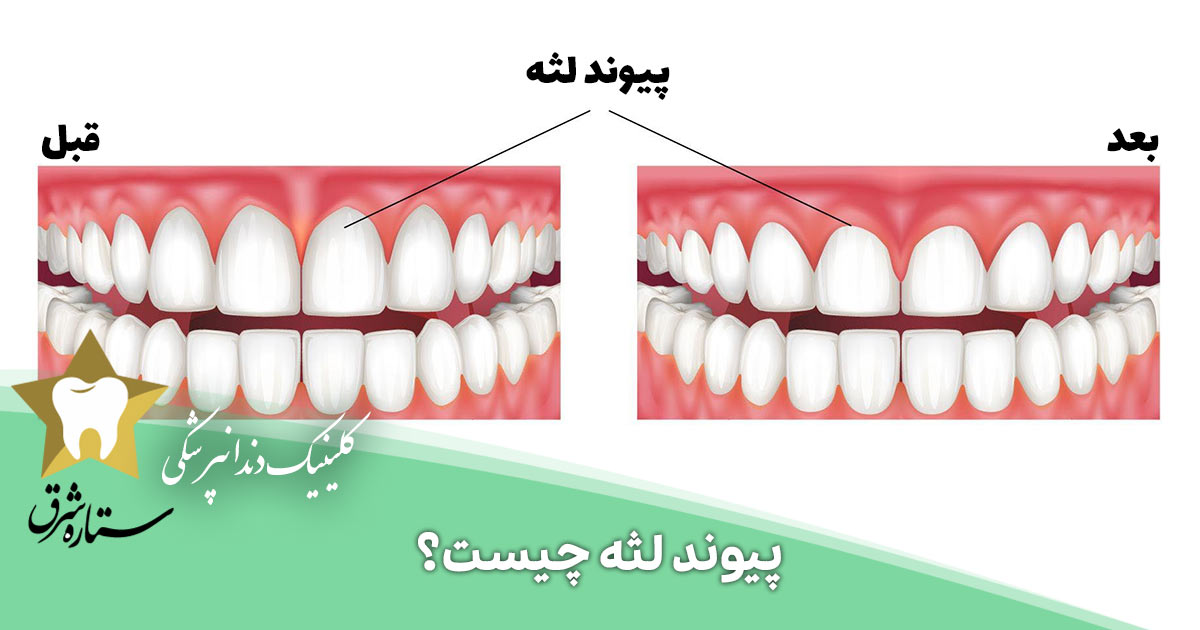 پیوند لثه چیست؟