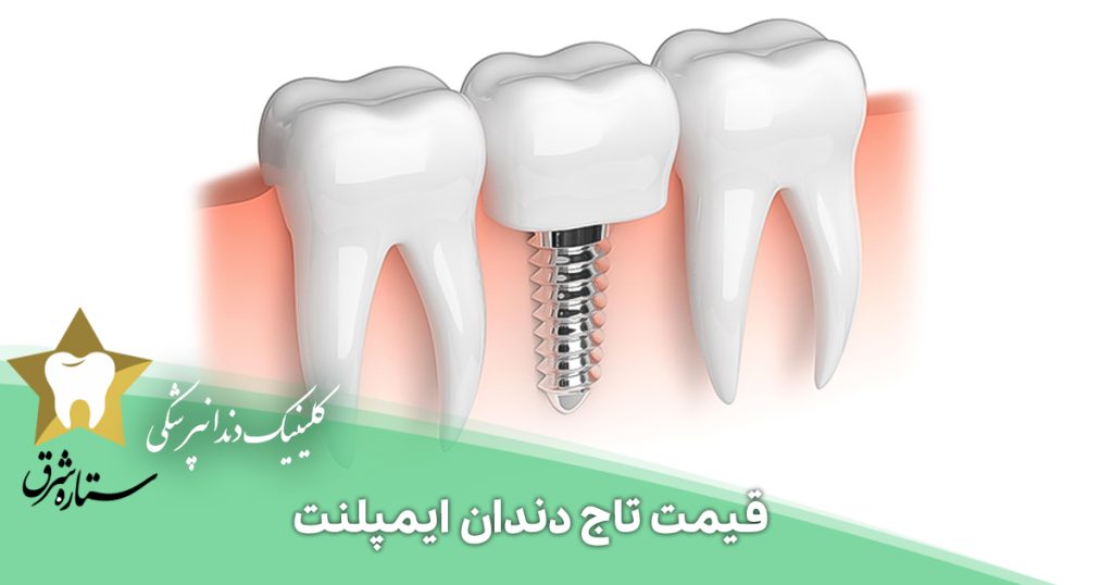 قیمت تاج دندان ایمپلنت