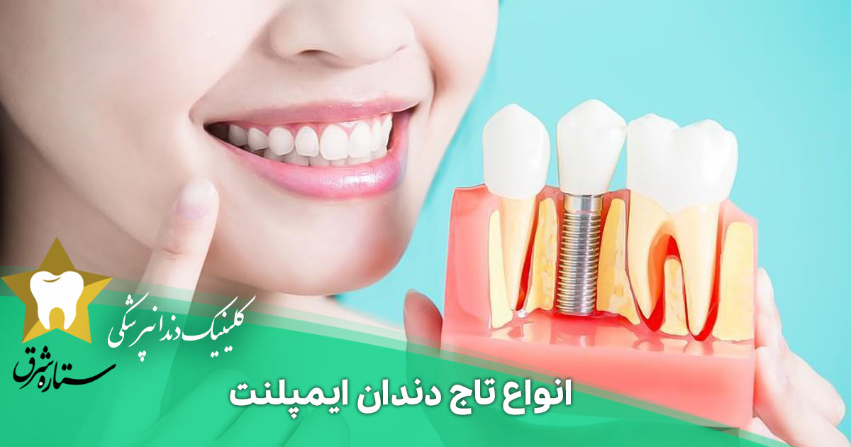 انواع تاج دندان ایمپلنت