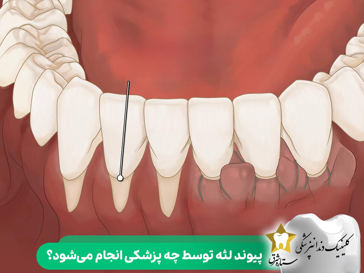 پیوند لثه توسط چه پزشکی انجام می‌شود؟